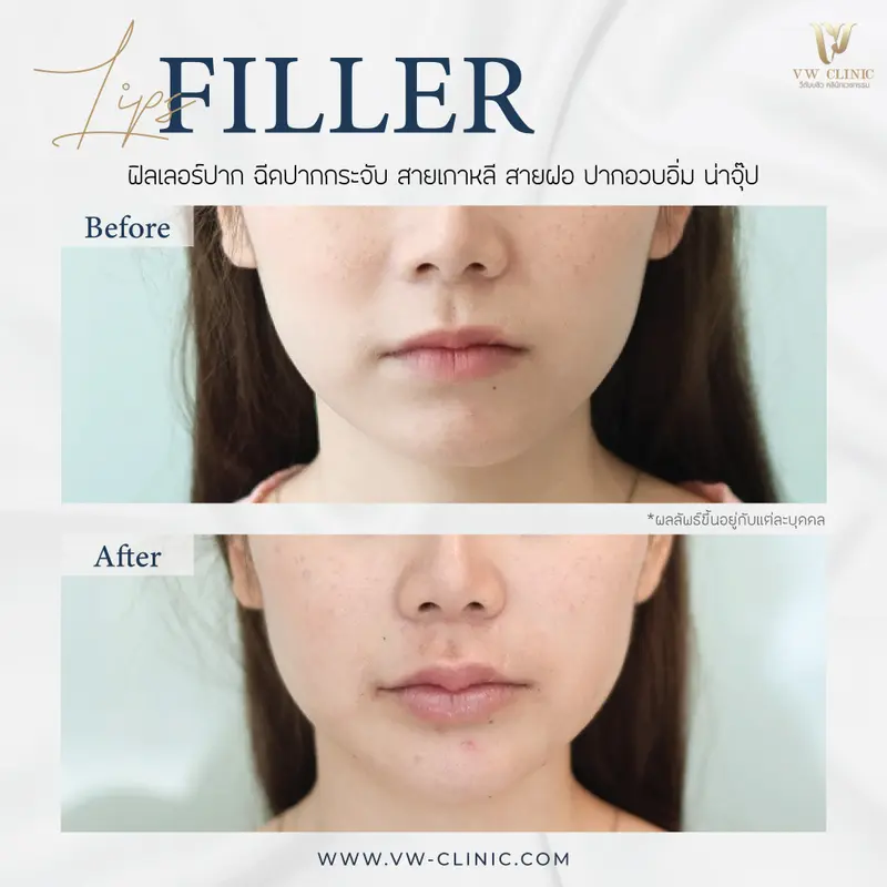 Filler ปาก