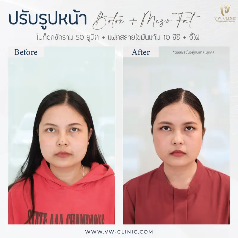 Botox กราม + Fat 10 cc แก้ม