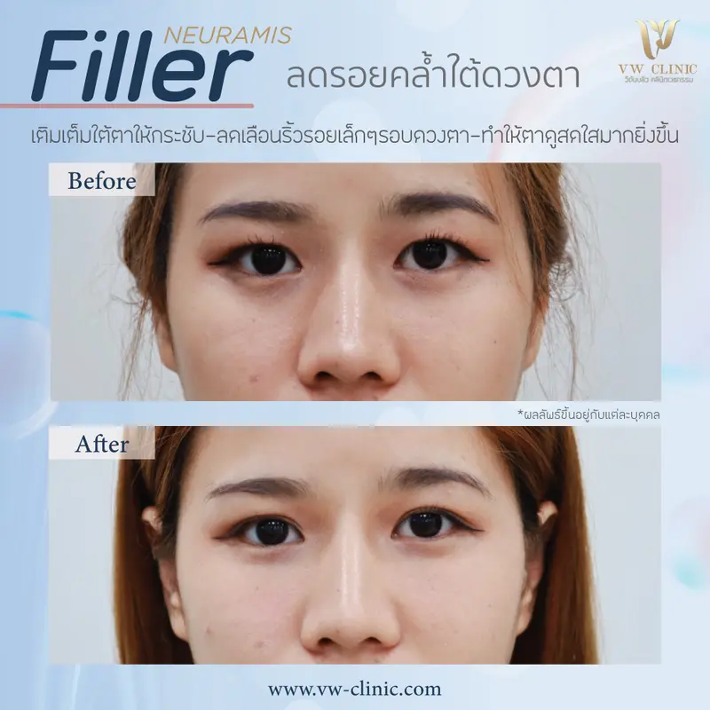 Filler ใต้ตา
