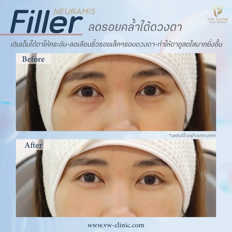 Filler ลดรอยคล้ำใต้ตา