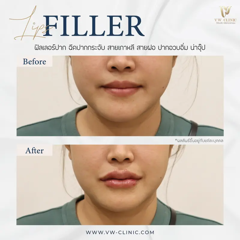 Filler ปาก