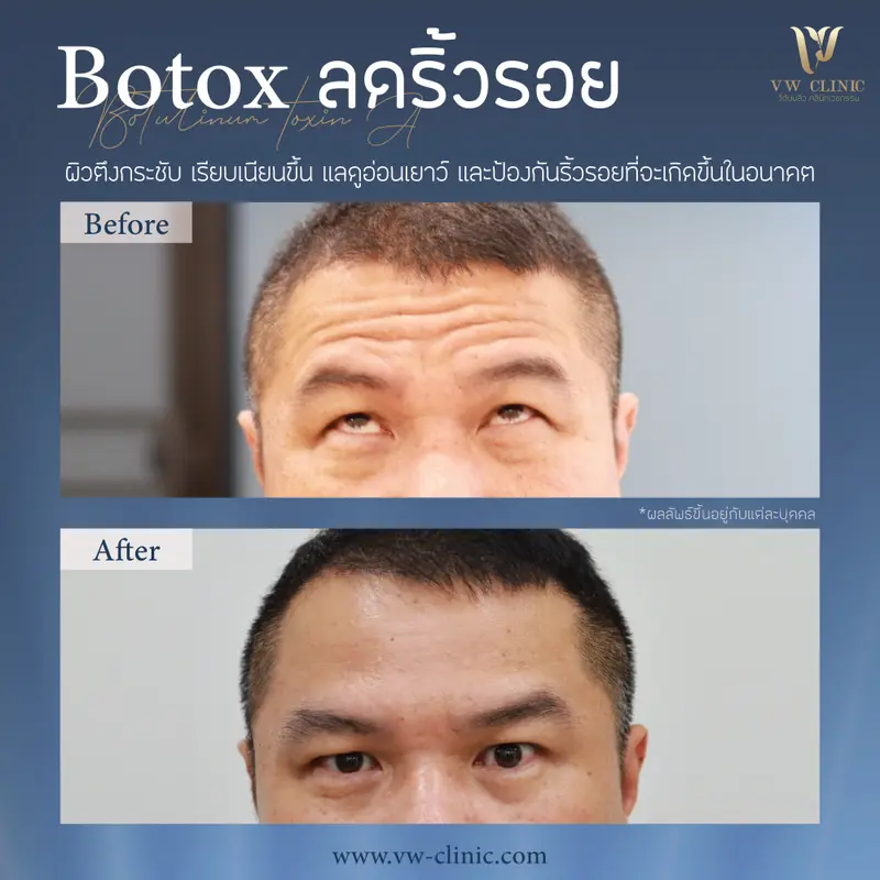 Botox ริ้วรอย 50 unit