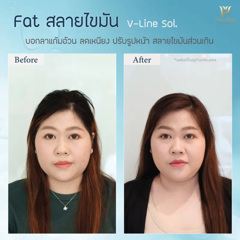 Fat 10 cc แก้ม