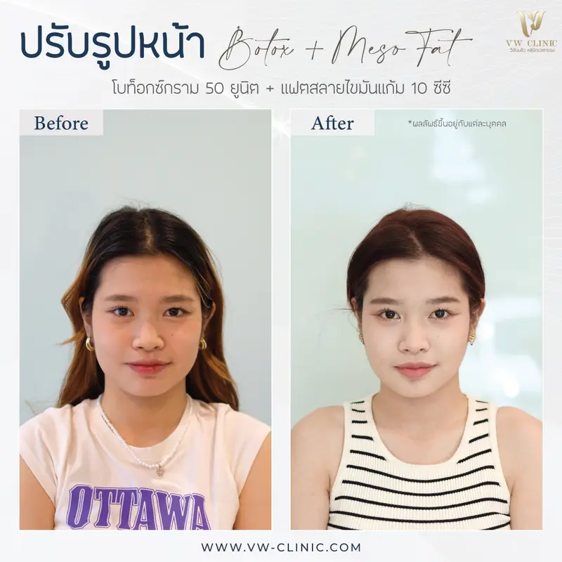 Botox กราม + Fat 10 cc แก้ม