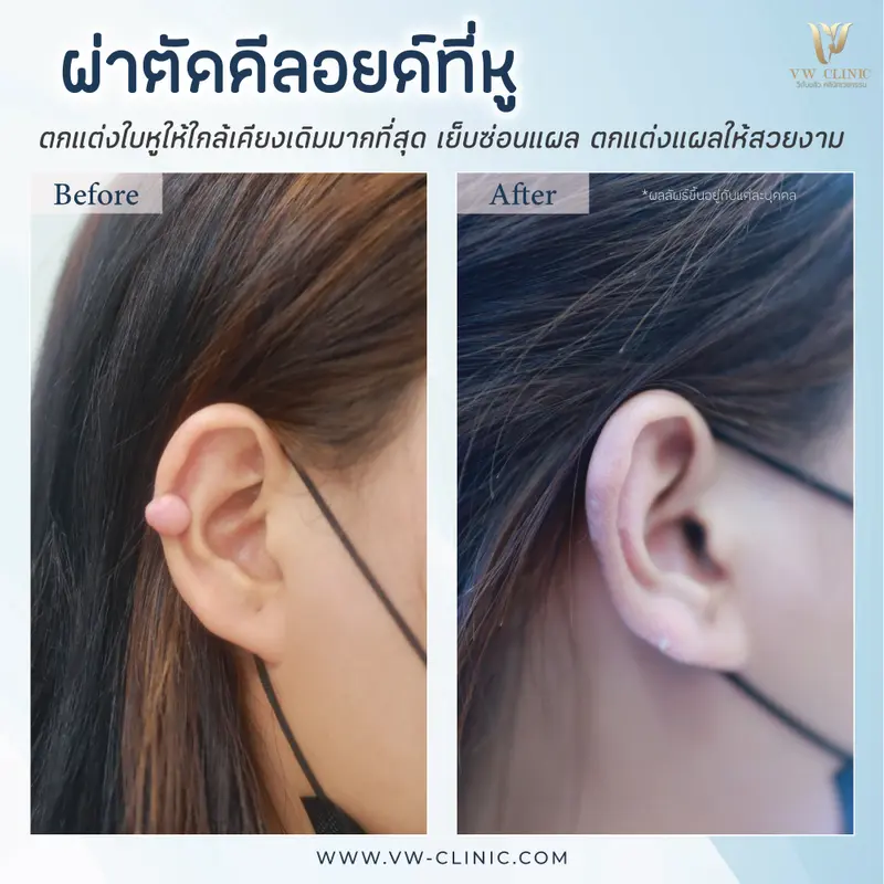 ผ่าตัดคีลอยด์หู