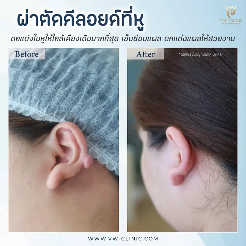 ผ่าตัดคีลอยด์หู