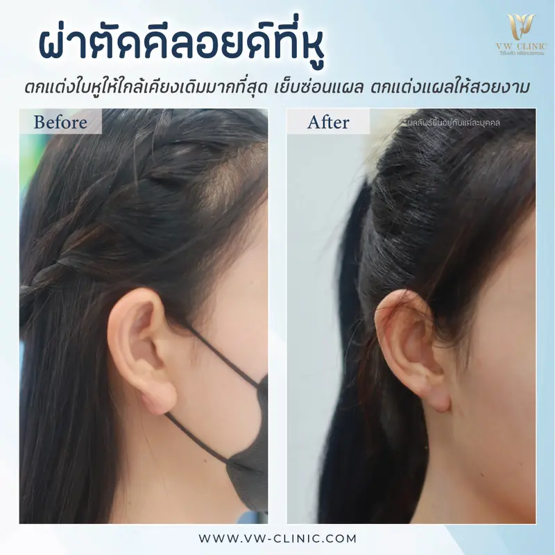ผ่าตัดคีลอยด์หู