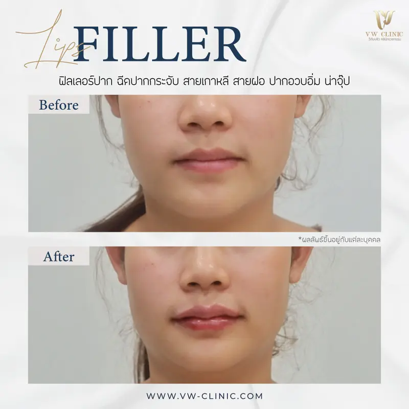 Filler ปาก