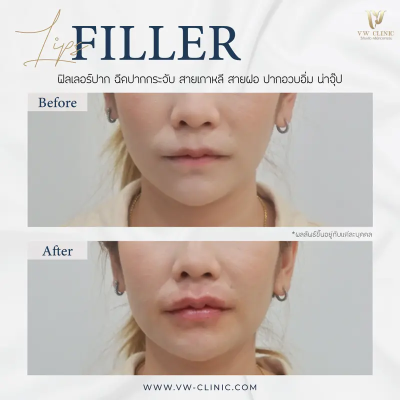 Filler ปาก