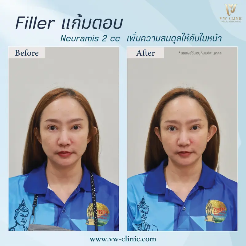 Filler แก้มตอบ 2 cc