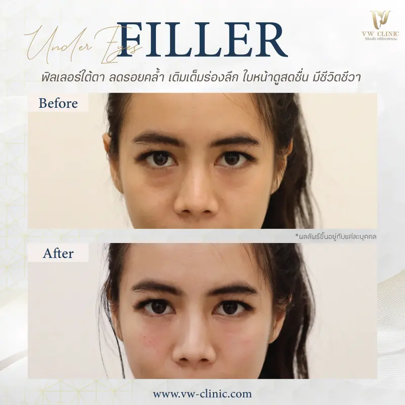 Filler ใต้ตา 