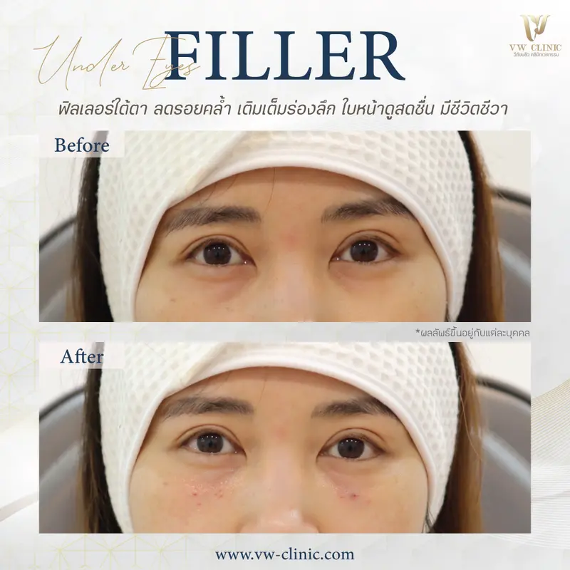 Filler ใต้ตา