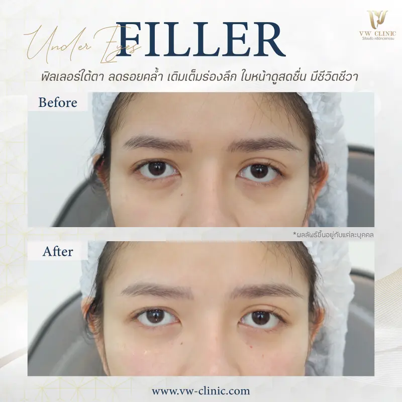 Filler ใต้ตา