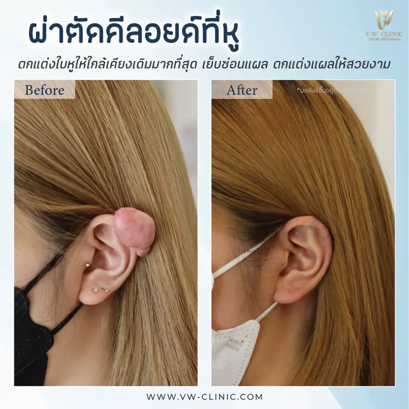 ผ่าตัดคีลอยด์หู