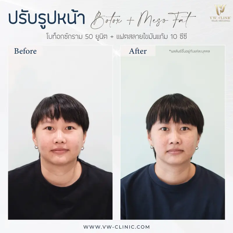 Botox กราม + Fat 10 cc แก้ม