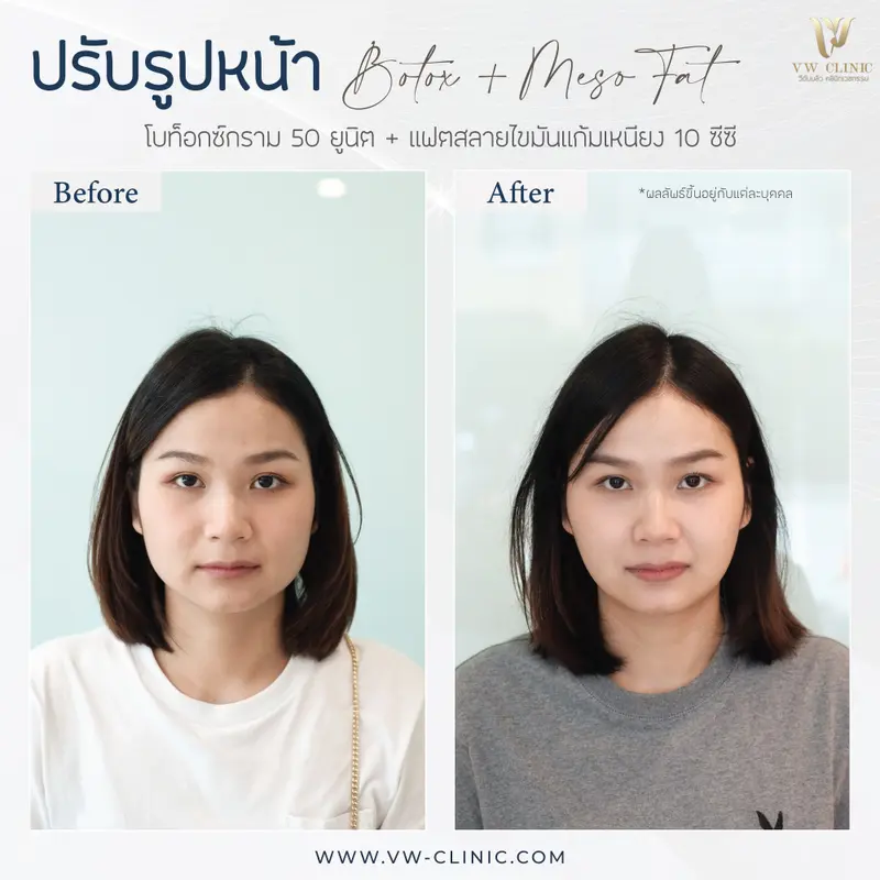 Botox กราม + Fat 10 cc แก้ม