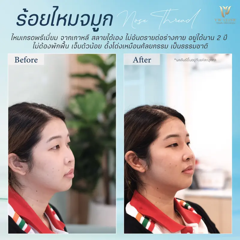 ร้อยไหมจมูก