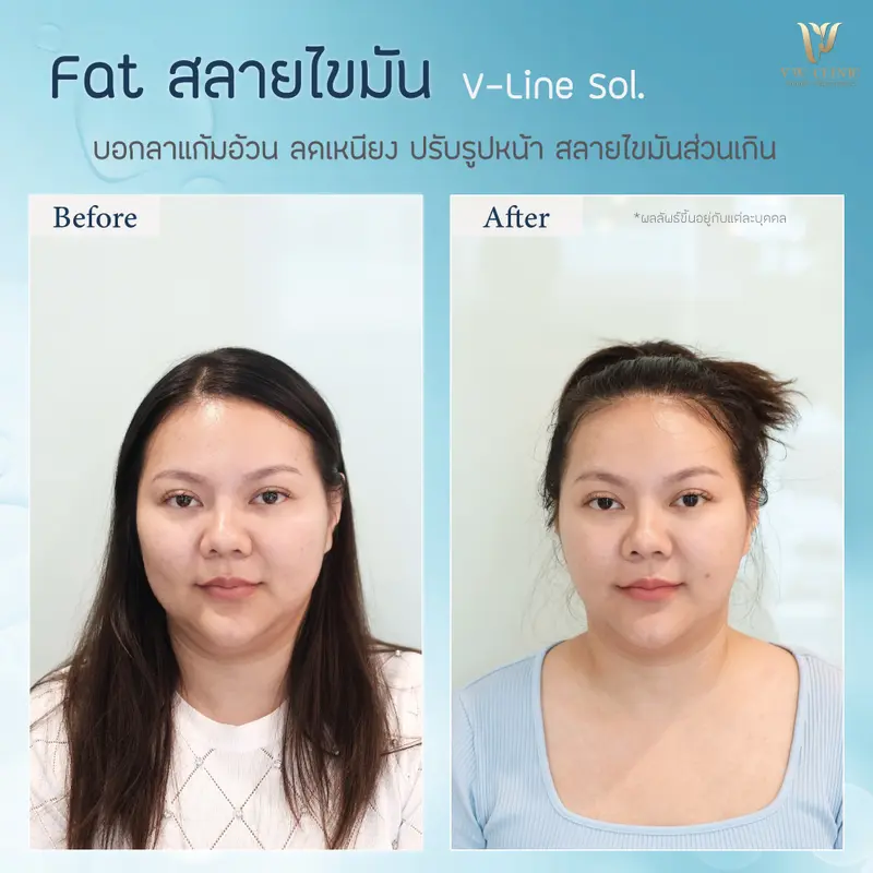 Fat 15 cc แก้มเหนียง