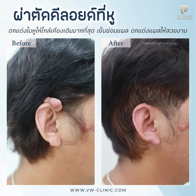 ผ่าตัดคีลอยด์หู