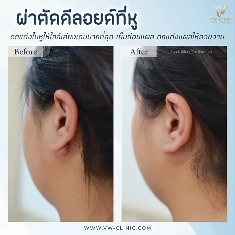ผ่าตัดคีลอยด์หู