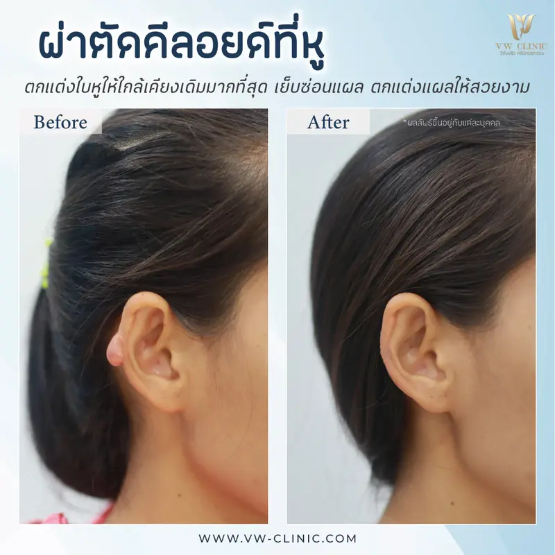 ผ่าตัดคีลอยด์หู