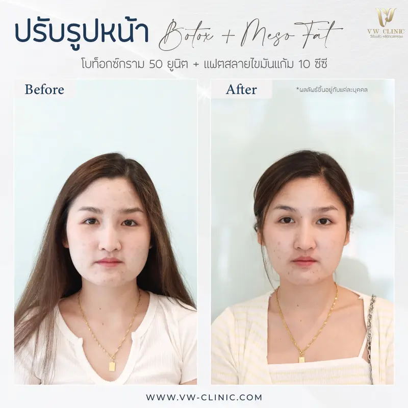 Botox กราม + Fat แก้ม