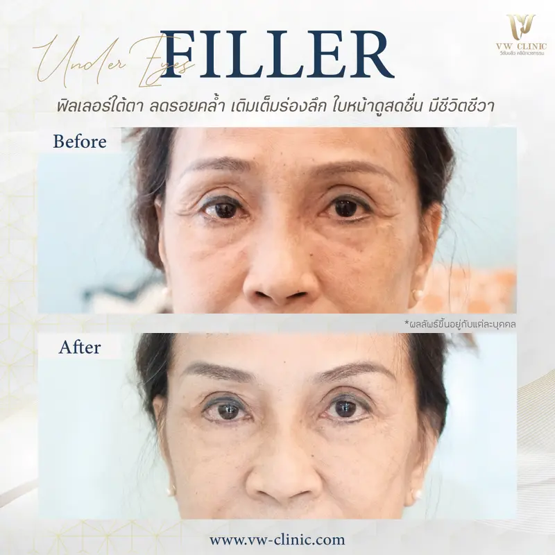 Filler ใต้ตา
