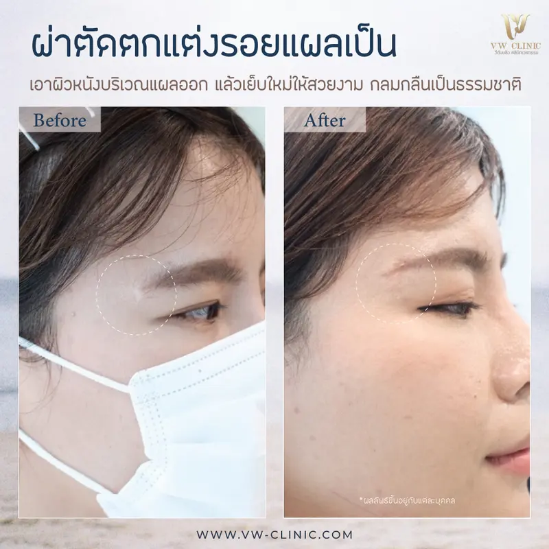 ผ่าตัดตกแต่งรอยแผลเป็นบริเวณหางคิ้ว