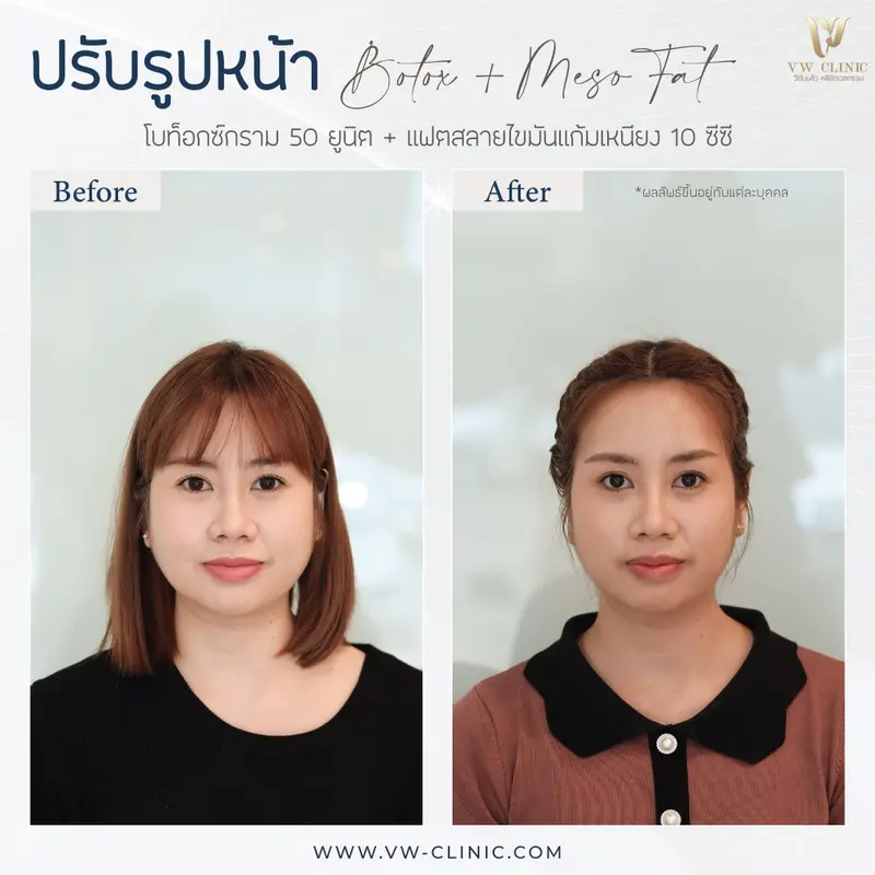 Botox กราม + Fat 10 cc แก้มเหนียง