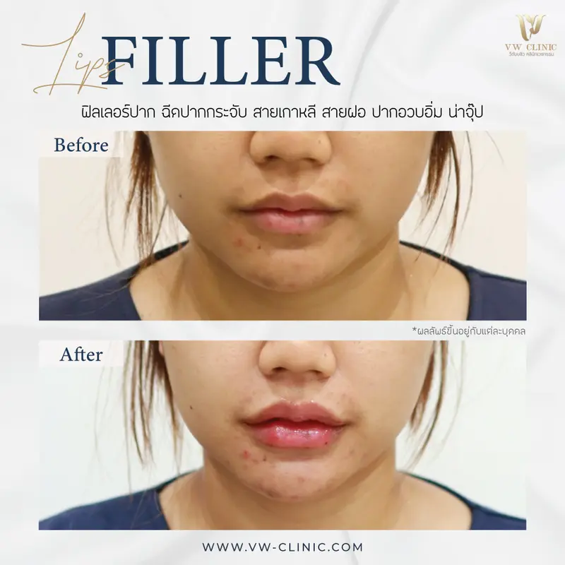 Filler ปาก