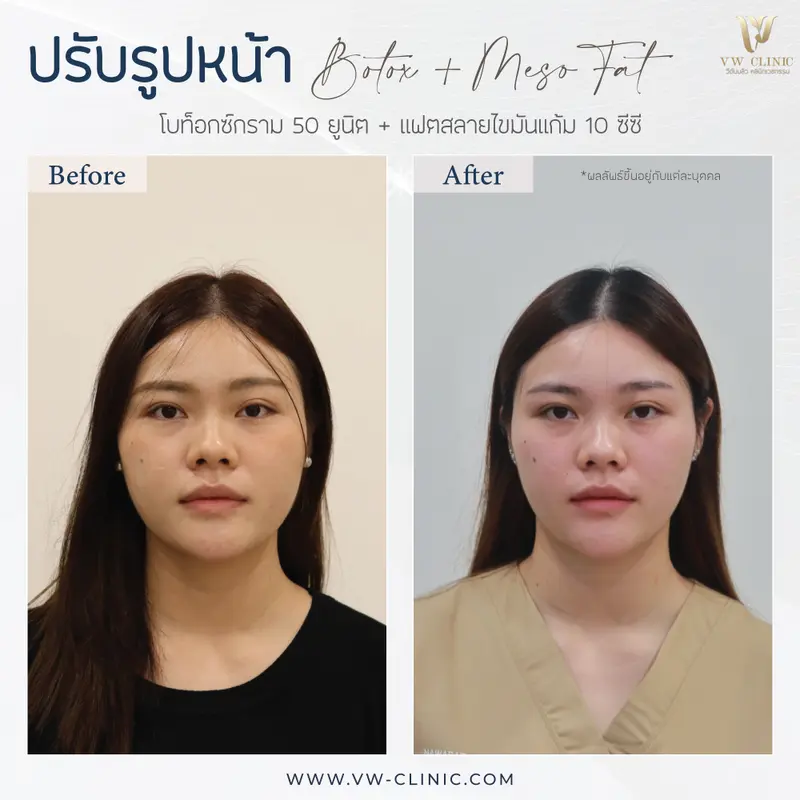Botox กราม + Fat 10 cc แก้ม