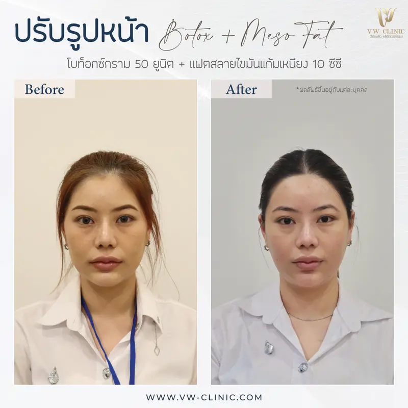 ฺBotox กราม + Fat 10 cc แก้มเหนียง
