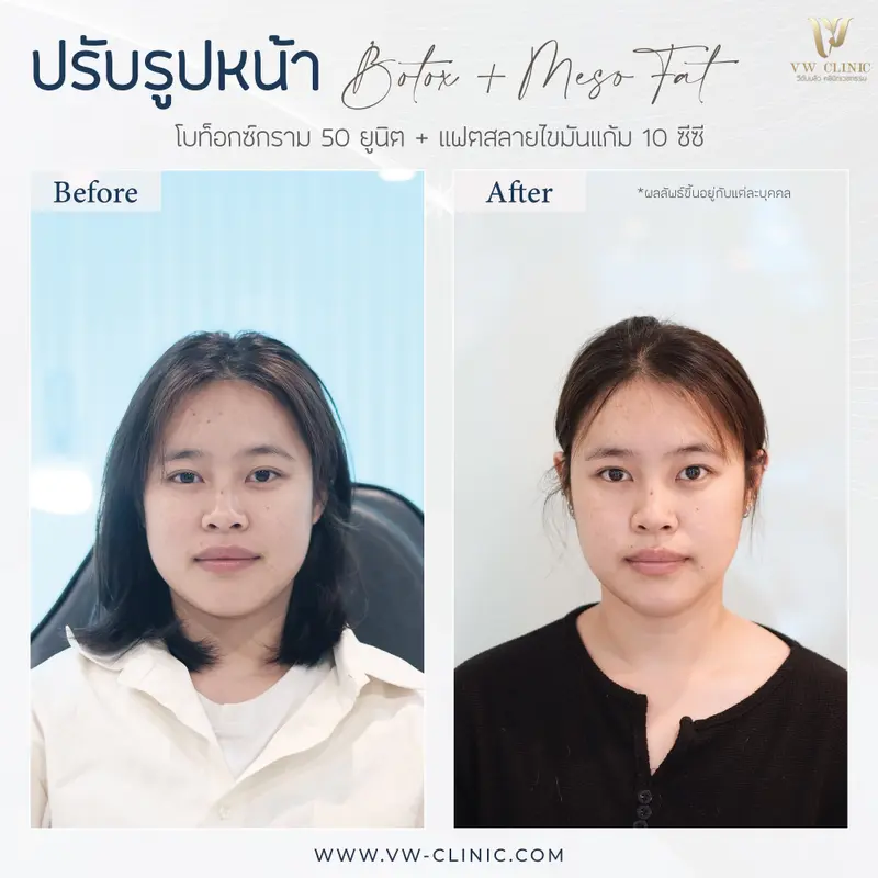 ฺBotox กราม + Fat 10 cc แก้ม