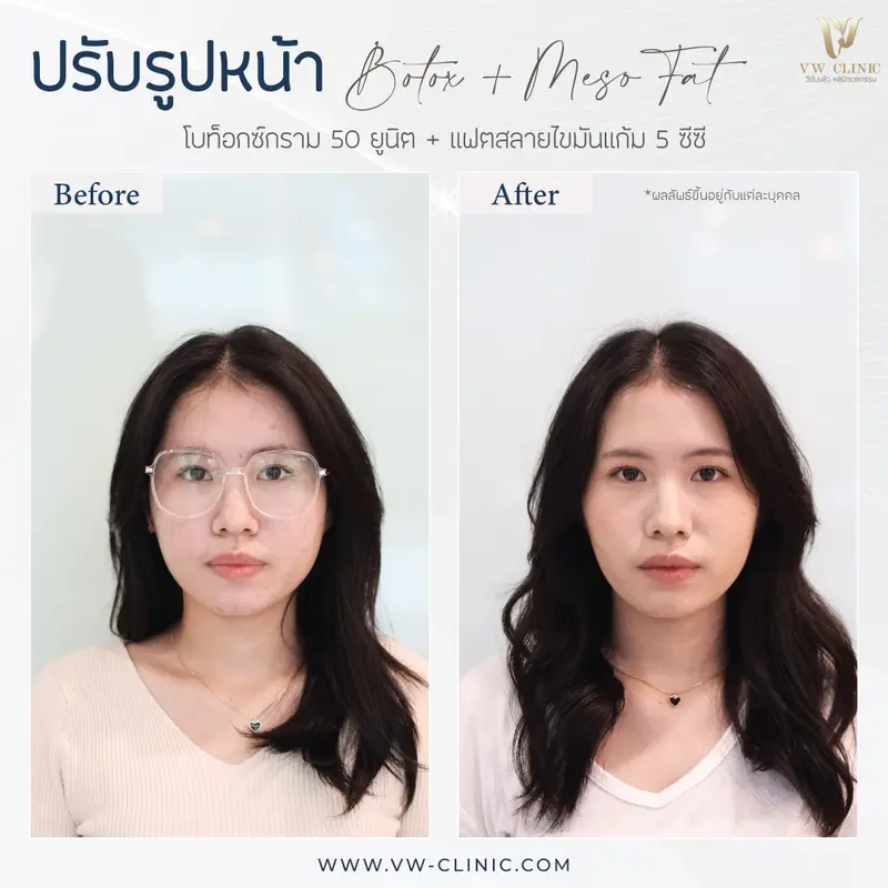 ฺBotox กราม + Fat 5 cc แก้ม