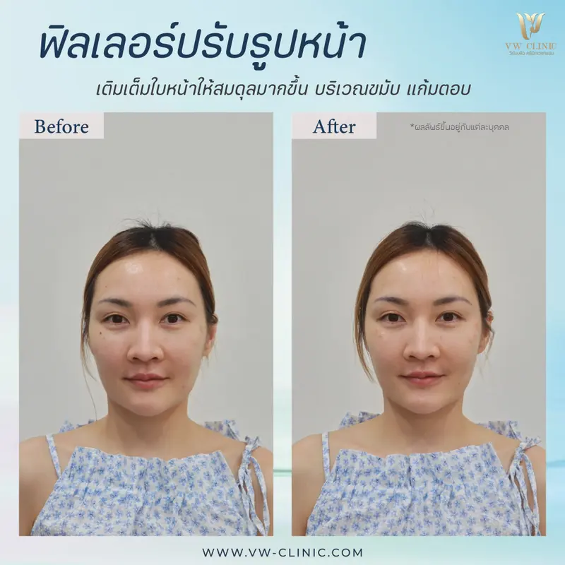 ขมับ + แก้มตอบ