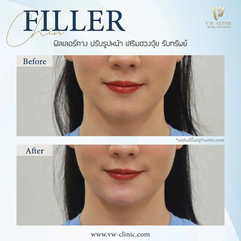 Filler คาง