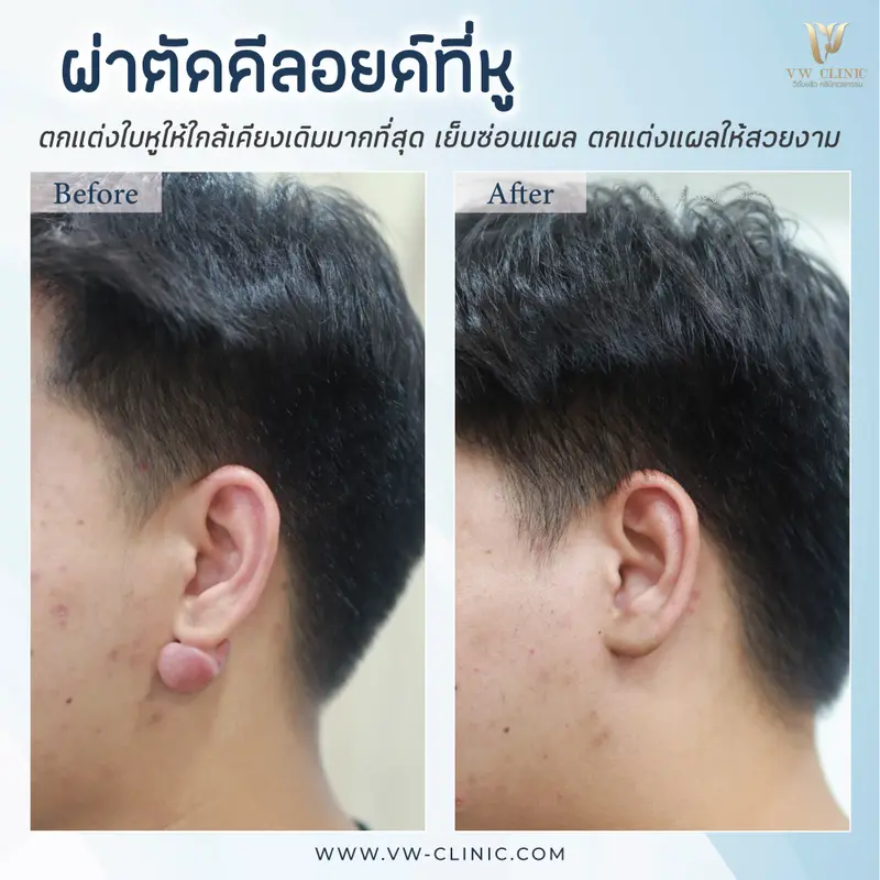 ผ่าตัดคีลอยด์หู