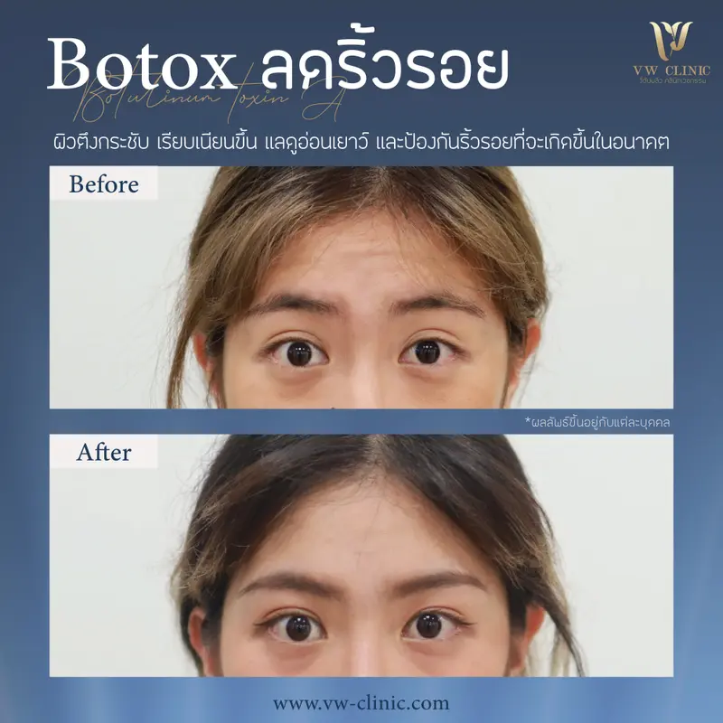 Botox ริ้วรอย