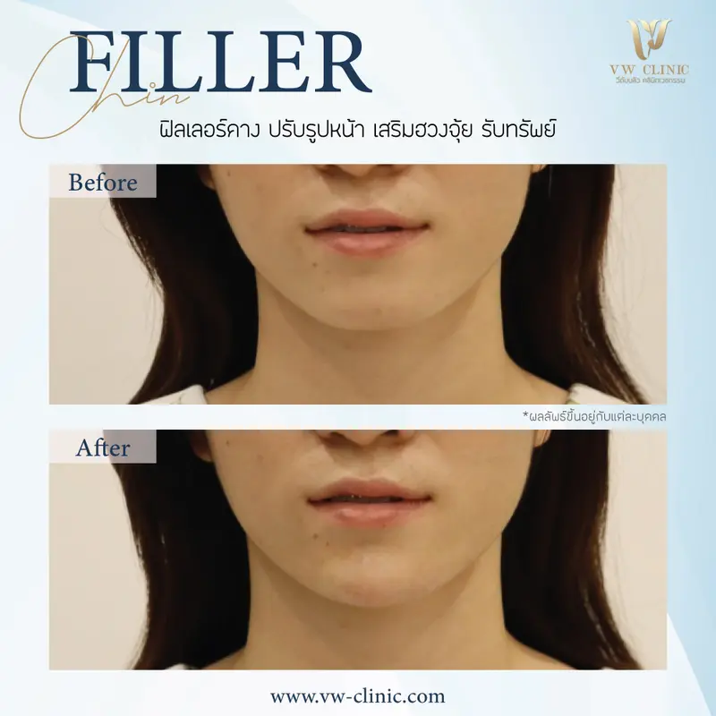Filler คาง