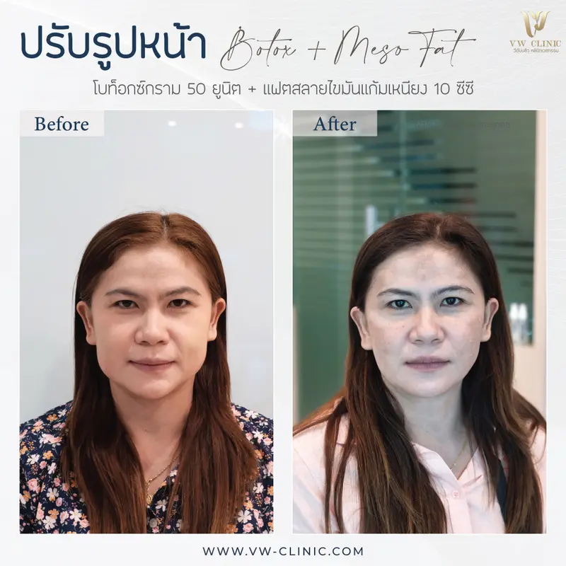 Botox 50 unit กราม + Fat 10 cc แก้มเหนียง