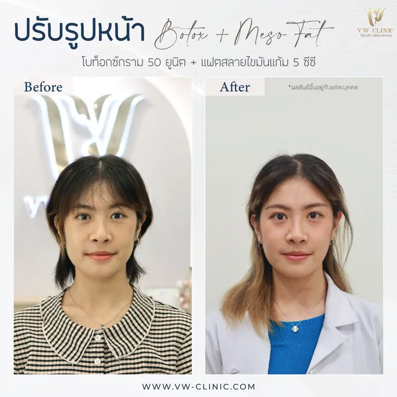 Botox 5o unit กราม + Fat 5 cc แก้ม
