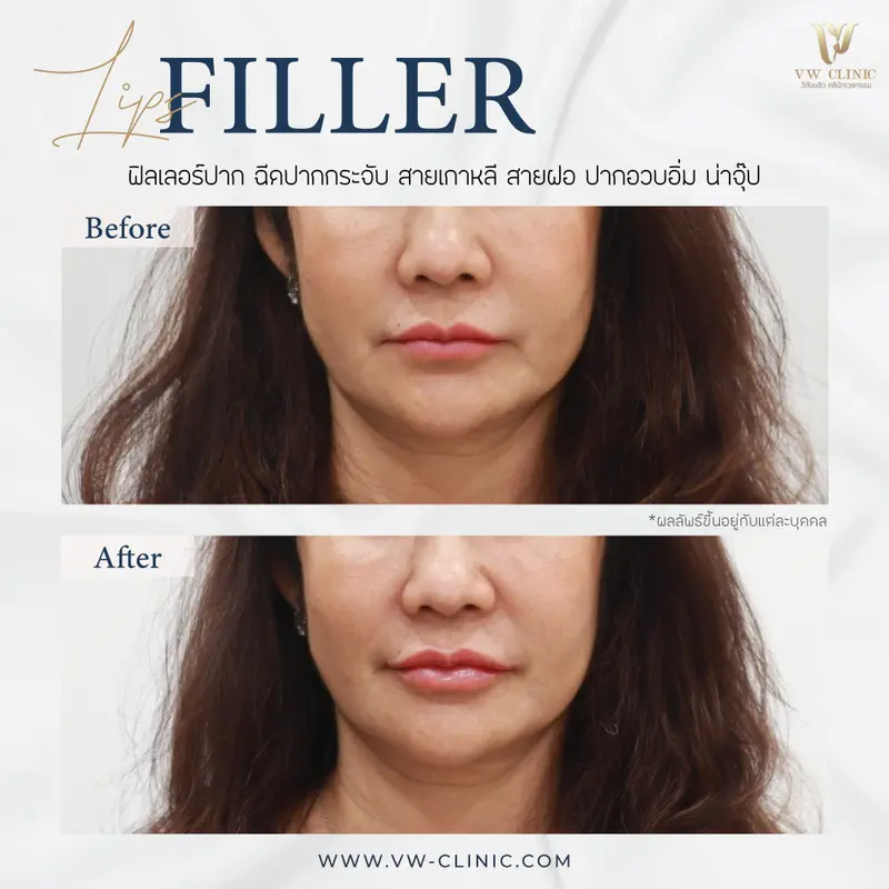 Restylane Kysse 1 cc