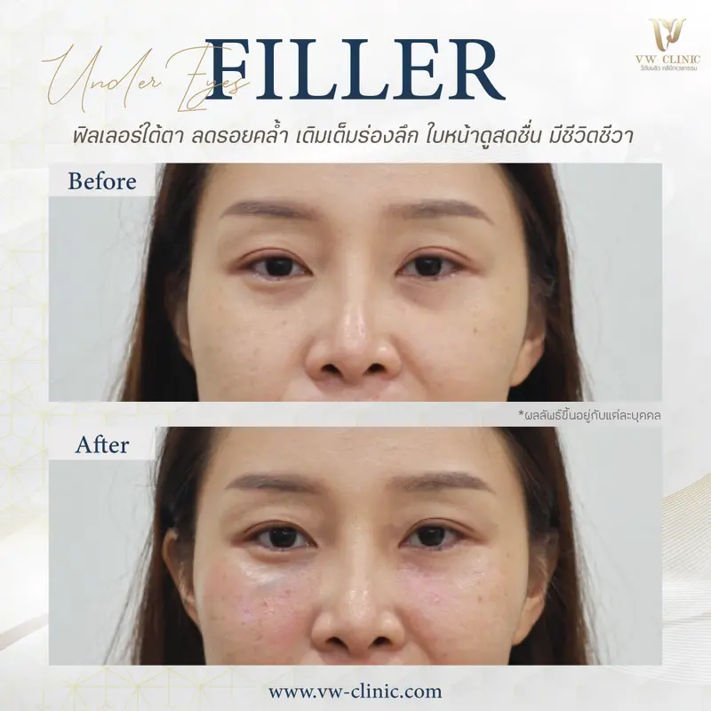 Filler ใต้ตา