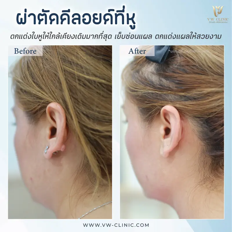 ผ่าตัดคีลอยด์หู