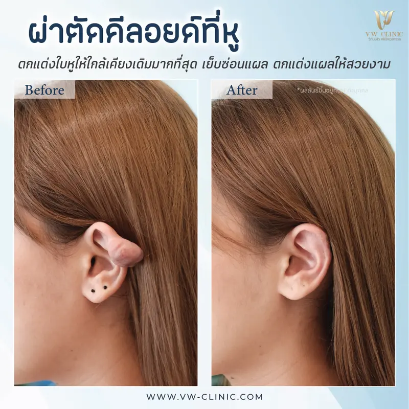 ผ่าตัดคีลอยด์หู
