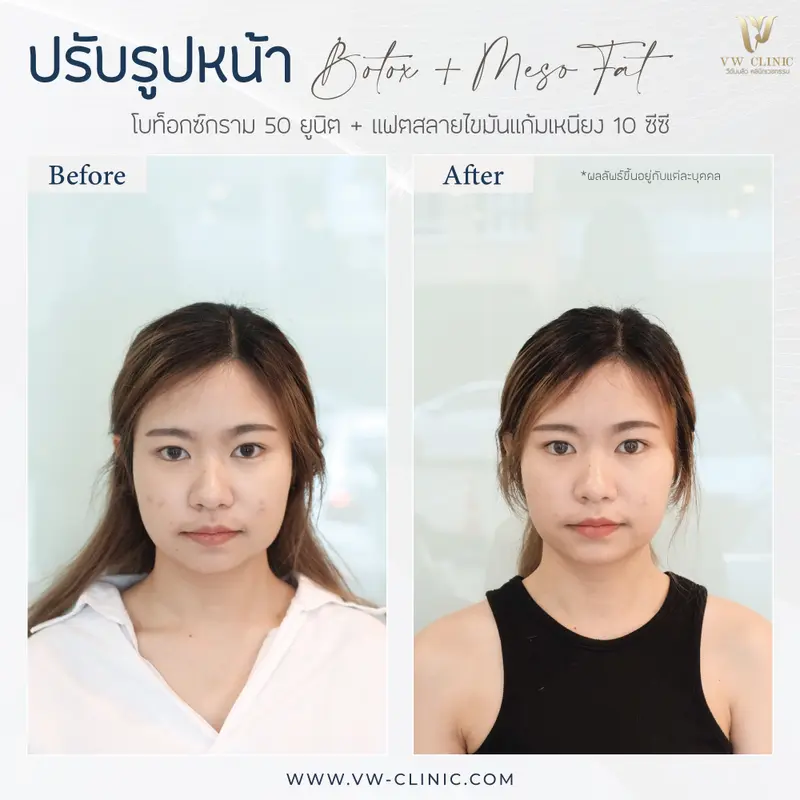 Botox กราม + Fat 10 cc แก้ม