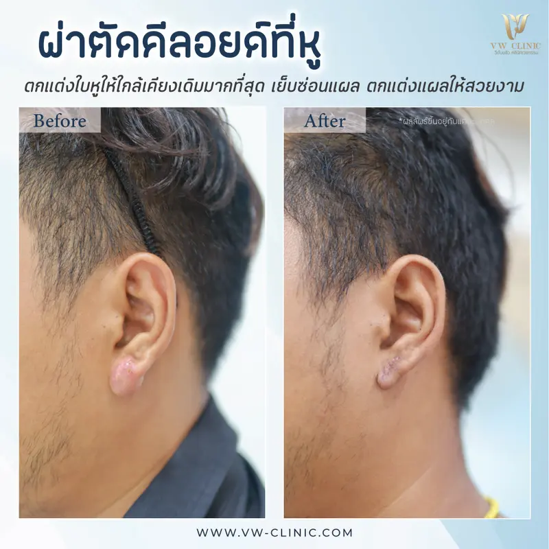 ผ่าตัดคีลอยด์หู