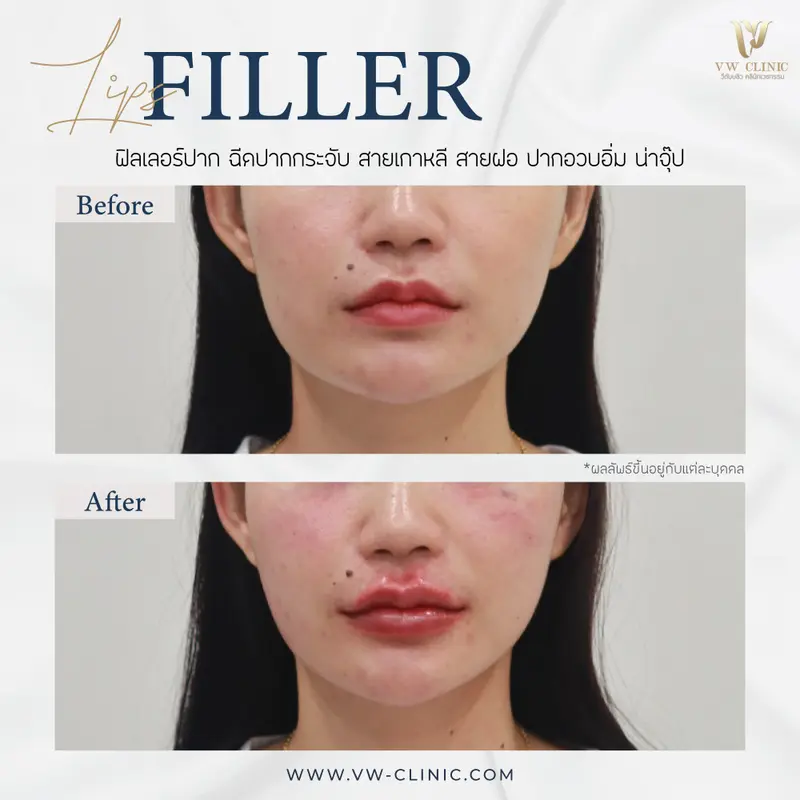 ฟิลเลอร์ปาก