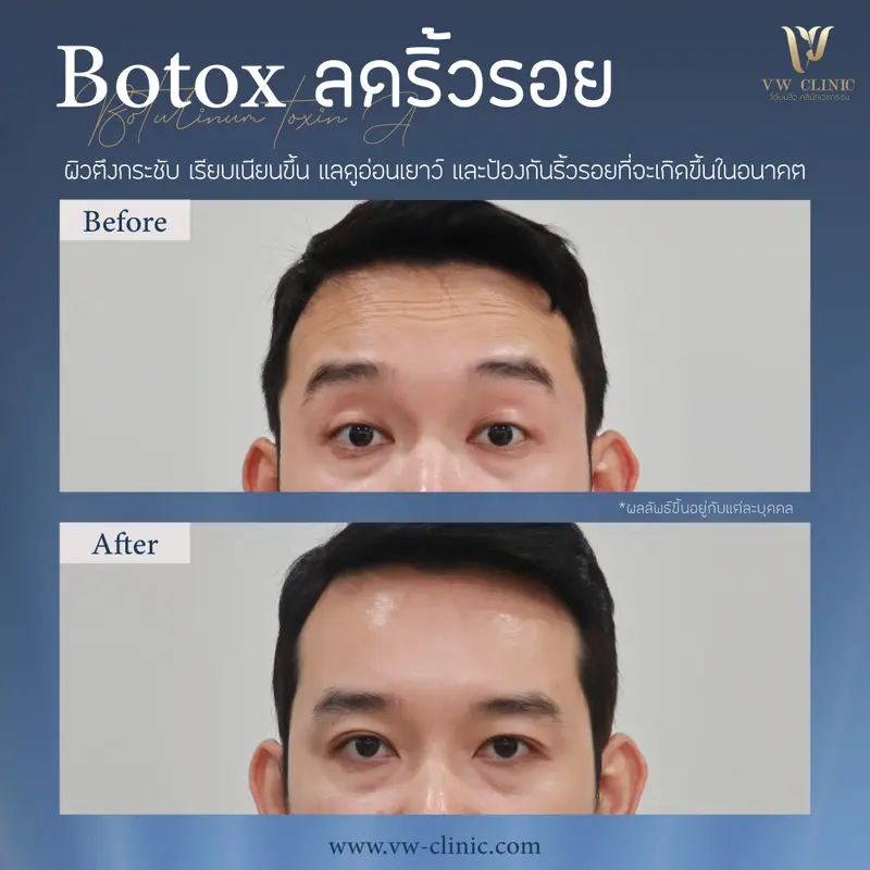 Botox ริ้วรอย