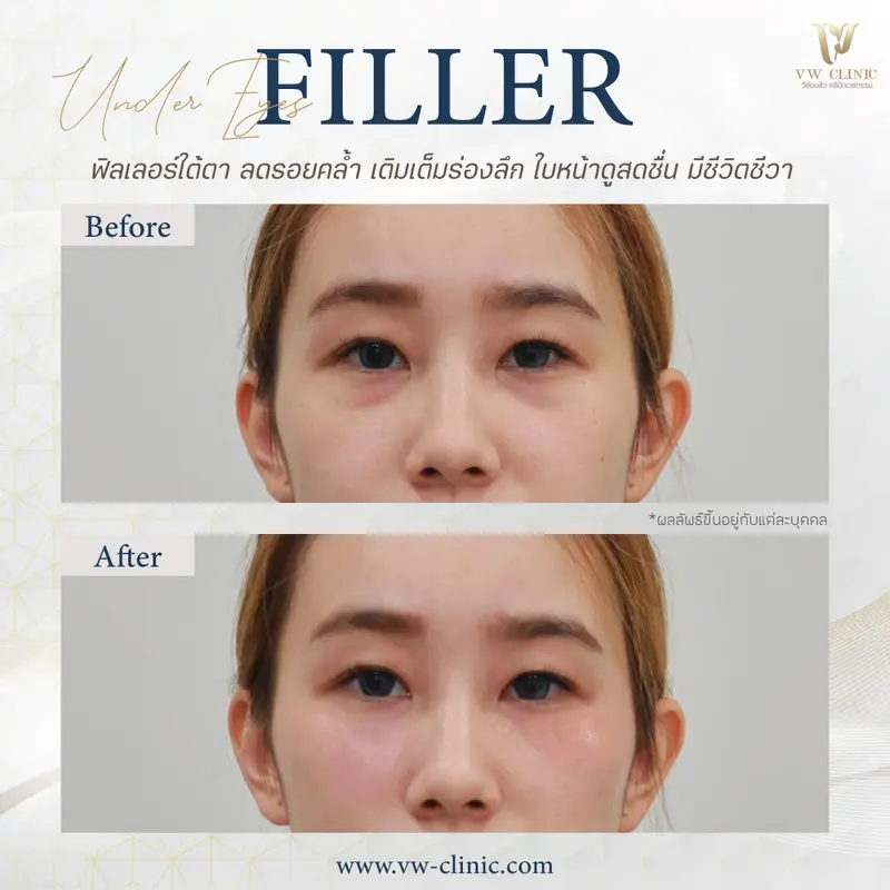 Filler ใต้ตา 2 cc